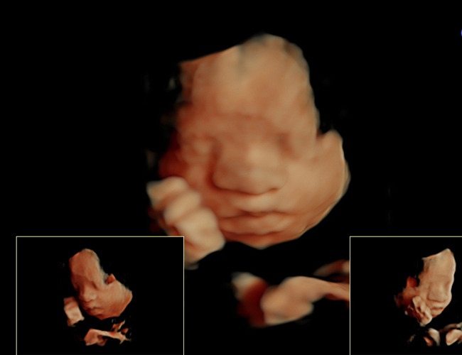 3D ultrasound image at 29 weeks